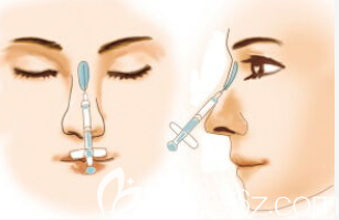 玻尿酸隆鼻示意圖