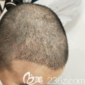 做發(fā)際線種植術(shù)后15天腫脹消失