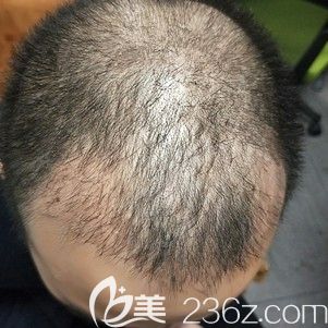 從30歲大叔到20歲小鮮肉的轉(zhuǎn)變就是我到武漢藝星整形找主任做了發(fā)際線種植