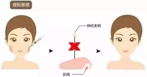 注射瘦臉瘦臉原理