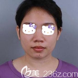 做鼻綜合與假體墊下巴術前照 做鼻綜合與假體墊下巴術前照