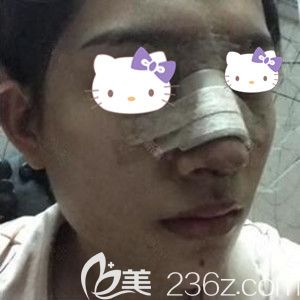 做鼻綜合與假體隆下巴整形術后3天照片 做鼻綜合與假體隆下巴整形術后3天照片
