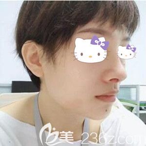 在華美做鼻綜合術后一周拆線效果圖 在華美做鼻綜合術后一周拆線效果圖