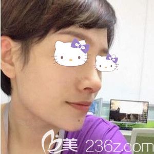 在海南華美做自體軟骨鼻綜合與假體墊下巴術后半個月效果照 在海南華美做自體軟骨鼻綜合與假體墊下巴術后半個月效果照