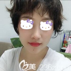 做完鼻綜合后對(duì)顏值提升有多大？看我找海南華美郭文煜做肋軟骨鼻綜合+假體墊下巴術(shù)后30天恢復(fù)效果圖就知道了！