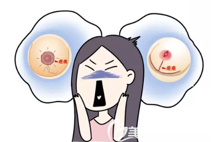 傳統(tǒng)乳房上提手術(shù)疤痕圖片