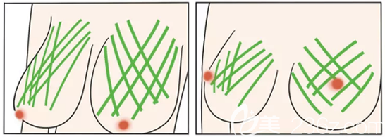 不開(kāi)刀人工韌帶乳房提升手術(shù)原理圖