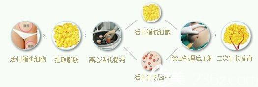 自體脂肪細(xì)胞移植過(guò)程示意圖