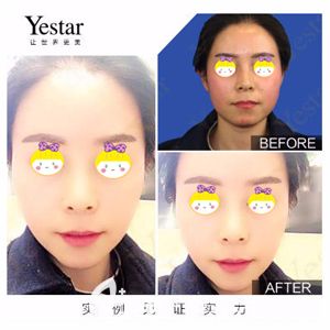 藝星洪霞醫(yī)生做射頻緊膚術(shù)后面部松弛改善明顯