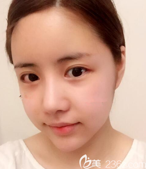 韓國朱諾整形做鼻子怎么樣 韓國朱諾整形做鼻子怎么樣