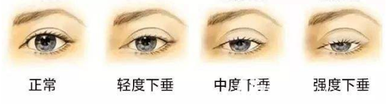 上瞼下垂的示意圖