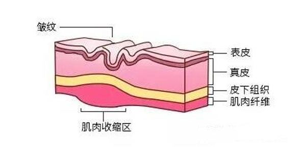 除皺針有什么危害及副作用呢