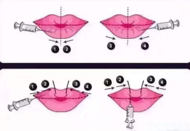 打嘟嘟唇的手術示意圖