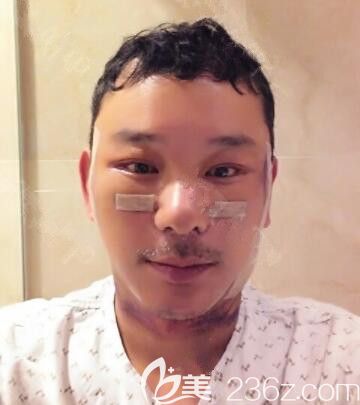 20190730_1564477693448803.jpg 術(shù)后7天_副本.jpg