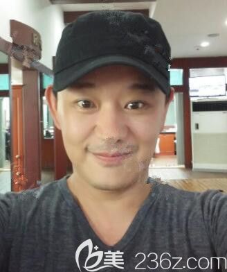 韓國(guó)JK整形臉部提拉、額頭提升、雙眼皮、鼻綜合3個(gè)月后讓人直呼不敢相信