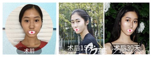 華美整形醫(yī)院做鼻綜合<span style= 華美整形醫(yī)院做鼻綜合<span style=