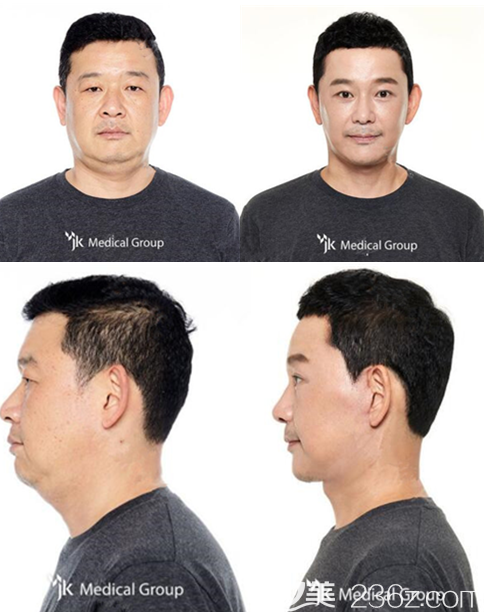 韓國jk整形面部拉皮真人案例 韓國jk整形面部拉皮真人案例