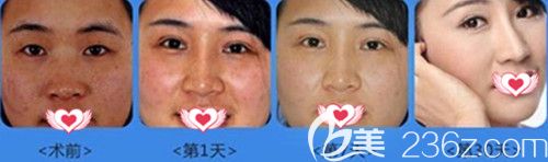 做激光祛斑<span style= 做激光祛斑<span style=