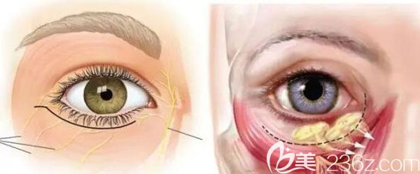 眼袋一旦形成怎么消除呢