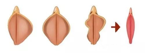 私密整形中陰蒂整形手術(shù)步驟簡(jiǎn)易圖