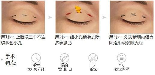 韓式三點雙眼皮手術(shù)原理分享