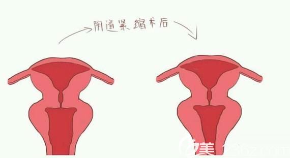 陰道緊縮術(shù)前術(shù)后對(duì)比效果