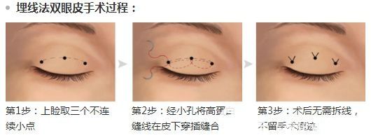 埋線法雙眼皮手術(shù)過程