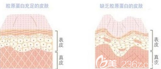 注射膠原蛋白示意圖