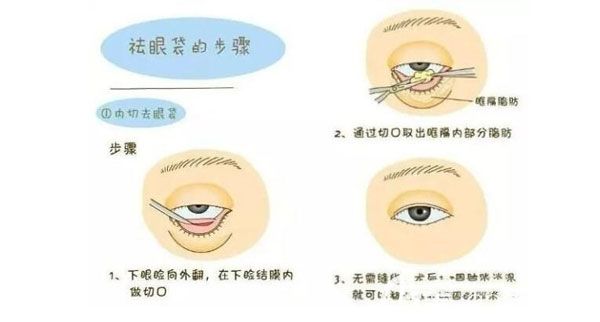 外切去眼袋手術(shù)