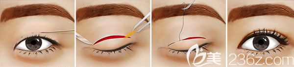 切開法雙眼皮手術(shù)原理分享