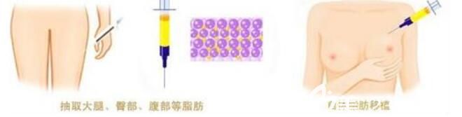 吸脂豐胸的方法