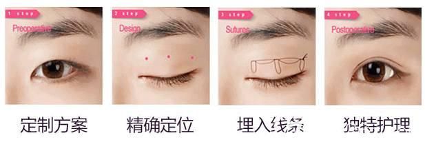 韓式三點雙眼皮手術(shù)原理