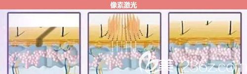 采用像素激光祛痘的手術(shù)原理改善皮膚的簡(jiǎn)易圖