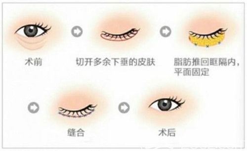 外切祛眼袋手術(shù)過(guò)程