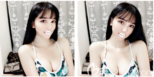 聽說廣州紫馨金孝憲做脂肪填充和鼻子都挺不錯的就找他做了自體脂肪豐胸和鼻綜合隆鼻