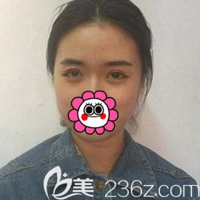 做埋線雙眼皮術后4天照片