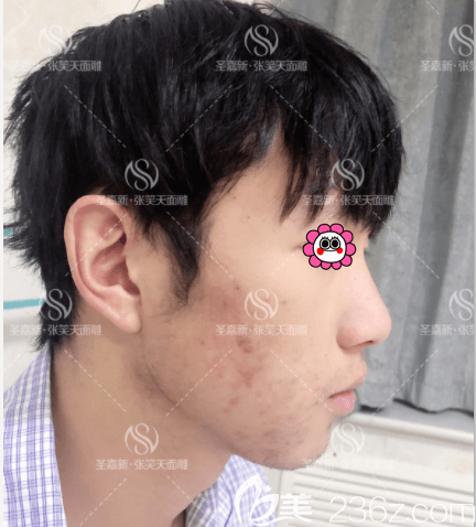 我在北京圣嘉新做下頜角長曲線截骨術(shù)第4天樣子