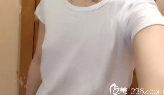 去合肥臺美麗格整形做假體隆胸前照片 去合肥臺美麗格整形做假體隆胸前照片