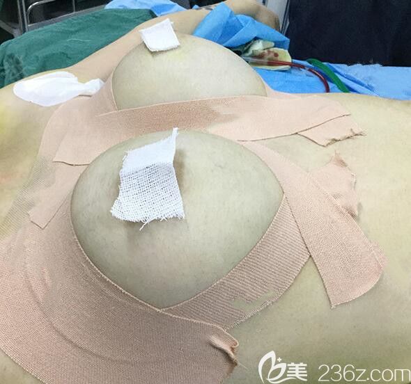 曼托假體隆胸+自體脂肪填充豐胸術(shù)后即刻照 曼托假體隆胸+自體脂肪填充豐胸術(shù)后即刻照