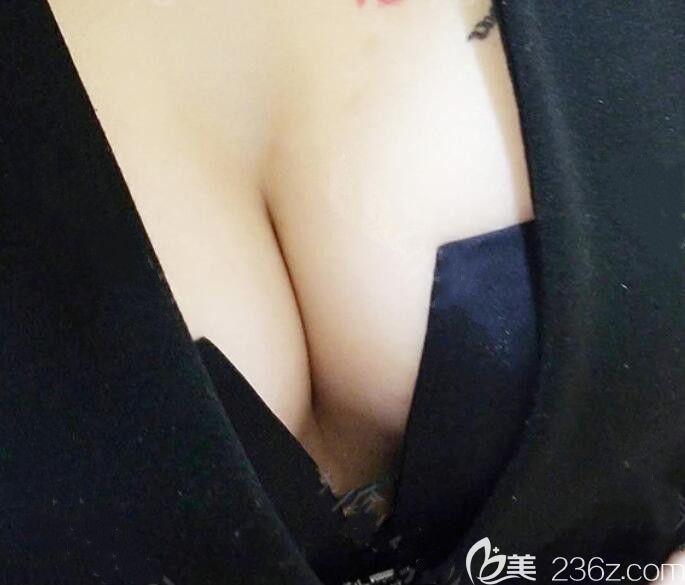 合肥臺美麗格整形隆胸術(shù)后第15天恢復(fù)圖 合肥臺美麗格整形隆胸術(shù)后第15天恢復(fù)圖