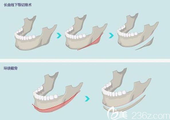 下頜角截骨手術(shù)示意圖