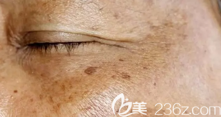 黃褐斑在臉上出現(xiàn)后的圖片