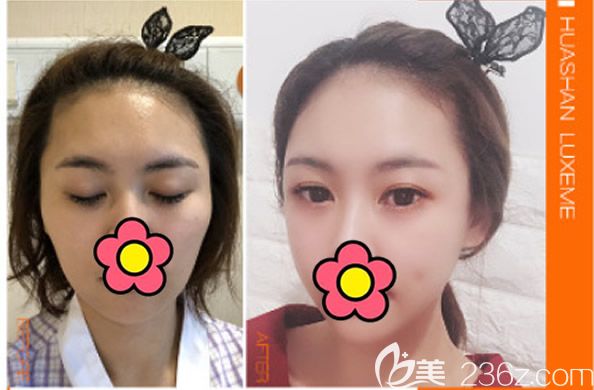 真人顴骨旋轉(zhuǎn)+顴骨縮小對比圖片