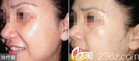 激光祛黃褐斑后的效果圖