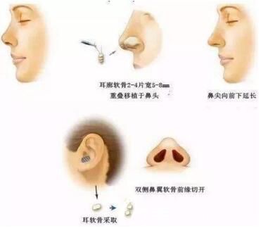 耳軟骨墊鼻尖好不好？會(huì)不會(huì)被吸收？