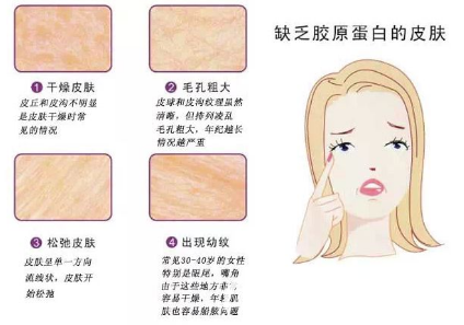 缺乏膠原蛋白的皮膚示意圖