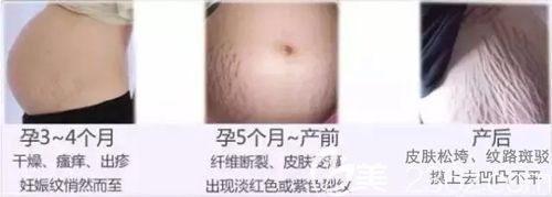 孕期中容易形成妊娠紋的時(shí)間以及紋路形態(tài)
