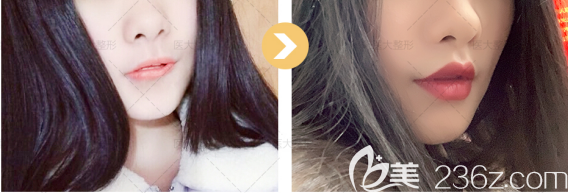 玻尿酸豐唇術(shù)后效果圖