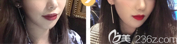 M唇整形術(shù)后效果圖