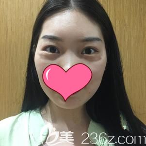 到武漢藝星做內(nèi)切去眼袋前的自己 到武漢藝星做內(nèi)切去眼袋前的自己